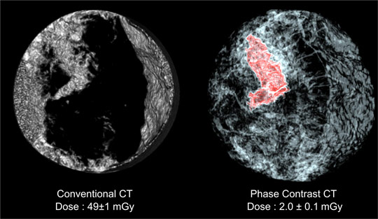 Comparison between a conventional CT scan of the breast sample and a scan using equally sloped tomography with phase contrast imaging.